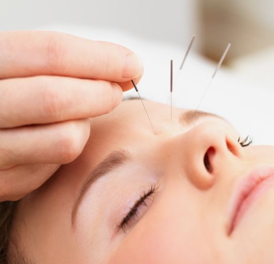 acupuncture nevroz 1 -foto