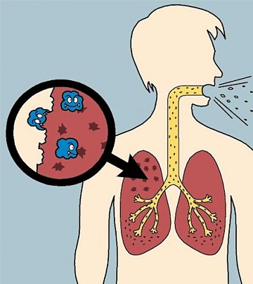 tuberculosis-foto