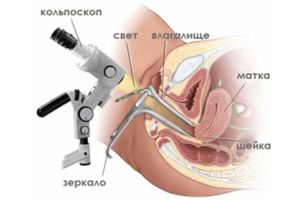 Кольпоскопия что показывает