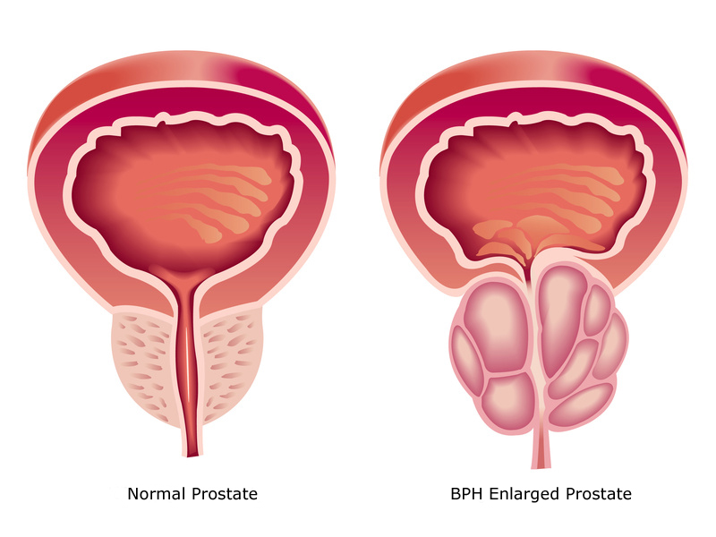 adenoma prostati-foto